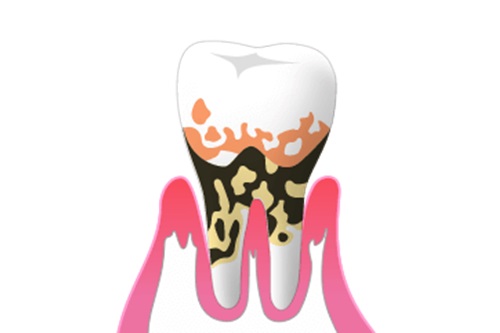 歯周病とは?